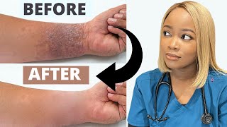 How to Treat ECZEMA  Black Brown skin  Dry Skincare Routine The 1 Best Remedy for Eczema [upl. by Shakespeare]