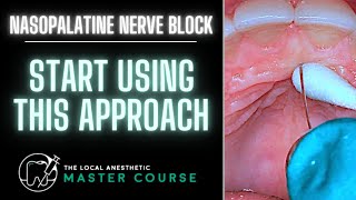 How to Do A Nasopalatine Nerve Block  Online Dental Continuing Education  LocalAnestheticcom [upl. by Ardnossak]