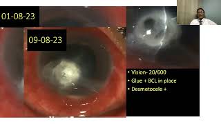 Lecture Microbial Keratitis in the Developing World [upl. by Elinore]