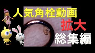 【鼻の角栓】人気角栓動画・総集編！～Black heads removal～ [upl. by Einafats]