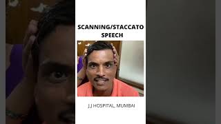 SCANNING STACCATO SPEECH [upl. by Otrebmuh]