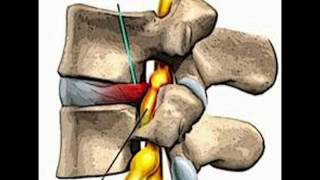 LUMBALGIA  LUMBOCIATALGIA CAUSAS DE LAS LESIONES [upl. by Jade]