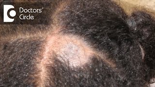 What causes Scalp Ringworm Effective Treatment   Tinea Capitis  Dr Tina Ramachander [upl. by Bushweller]