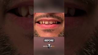 See How He FIXED His Gapped Teeth with SnapOn Veneers [upl. by Dorahs262]