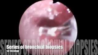 bronchial biopsy [upl. by Sandie926]