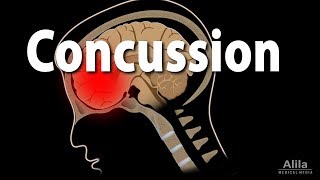 Concussion Pathophysiology Causes Symptoms and Treatment Animation [upl. by Wesley]