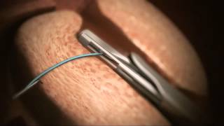 Animation of Urolift® System for BHP  Treatment now available at Genesis Healthcare [upl. by Haelahk]