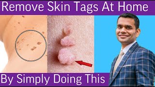 Remove Skin Tags  Home Remedies To Remove Skin Tags  Dr Vivek Joshi [upl. by Thistle]