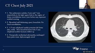 Central Valley Chronicles Challenging Coccidiomycosis Cases in PWH [upl. by Nwadrebma]