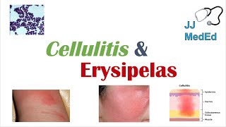 Cellulitis vs Erysipelas  Bacterial Causes Risk Factors Signs and Symptoms Treatment [upl. by Lundin31]