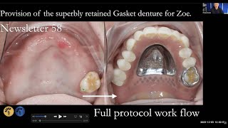 Upper gasket partial denture by Finlay Sutton Newsletter 58 walk through video [upl. by Ttenneb]