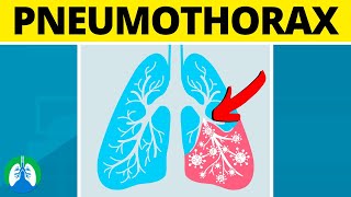 Pneumothorax Medical Definition  Quick Explainer Video [upl. by Edroi]