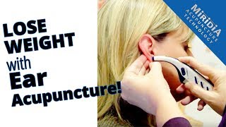 Ear Acupuncture for Weight Loss [upl. by Essinger]