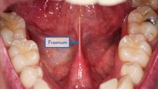 How To Check Your Mouth A Guide To Spotting Mouth Cancer [upl. by Tezzil]