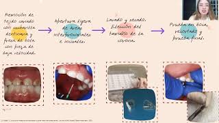 quotCoronas de celuloide con ionómero de vidrioquot Anet Larissa Guerrero López [upl. by Barboza]