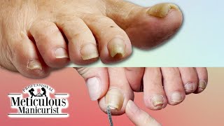 Pedicure THICK Pincer Toenail [upl. by Udele821]