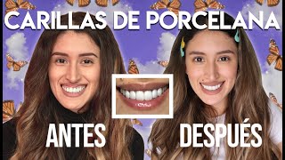 Carillas Dentales de Porcelana Antes y Después Mi Experiencia Paso a Paso y Más [upl. by Aila]