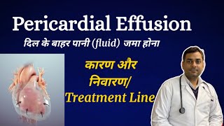 Pericardial effusion in hindi detail  pericardial effusion treatment line [upl. by Noelyn]