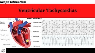 Identifying the Different Types of Ventricular Tachycardias [upl. by Ebneter]