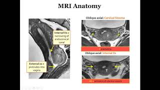 International Cancer Imaging Society Course Oct 17 Imaging uterine tumors Alberto Vargas [upl. by Aluk]