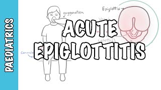 Acute Epiglottitis  signs and symptoms causes pathophysiology treatment [upl. by Dinan998]