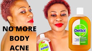 How to Use Dettol to Get Rid of Body Acne For Good  Clear Acne Scars and Pimples [upl. by Fransisco]