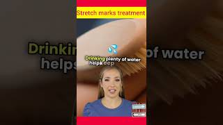 stretch marks treatment shorts youtubeshorts ytshort [upl. by Ahsenad]