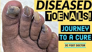 Diseased Toenails Journey To A Cure Trimming Fungal Toenails Onychomycosis [upl. by Nottage]