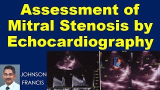 Assessment of Mitral Stenosis by Echocardiography [upl. by Trinette]