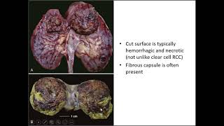 Renal Tumor Pathology Case 4 [upl. by Farand]