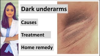 How to get rid of Dark underarms  causes treatment home remedy Dermatologist  Dr Aanchal [upl. by Battista]