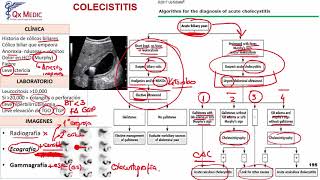 Colecistitis [upl. by Sachs]