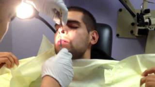 Septoplasty Nasal Splint Removal [upl. by Nuoras]