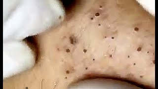 Amazing Blackheads just wait for it [upl. by Llerut]