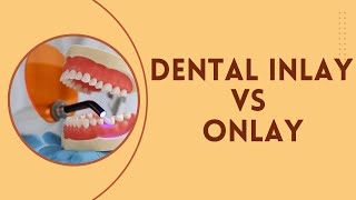 Dental Inlay vs Onlay What are their differences [upl. by Osithe317]