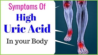 Signs and symptoms of high uric acid level in a body [upl. by Sumahs]