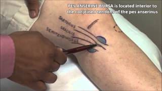 Pes Anserine Bursitis Injection [upl. by Keraj]