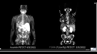 Axumin VS Pylarify PSMA PETCT [upl. by Boudreaux]