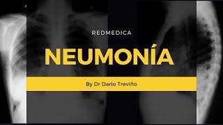 Neumonia Etiologia diagnostico y tratamiento ENARM [upl. by Benilda602]