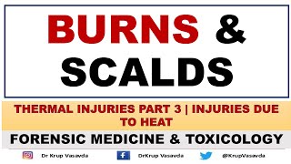 Burns and Scalds  Thermal Injuries  Forensic Medicine  Dr Krup Vasavda [upl. by Gurney647]