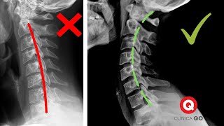 Rectificación Cervical ¿Qué es Ejercicios y Consejos [upl. by Barthelemy]