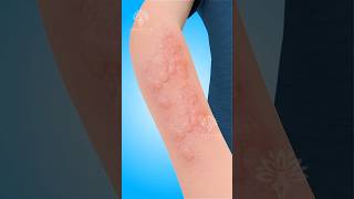 Hives What Happens Inside Your Body 😮 shorts urticaria  Creativelearning3d [upl. by Ornstead13]