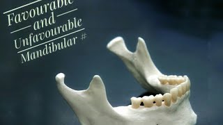 Mandibular Fractures  Favourable and Unfavourable [upl. by Ibbison52]