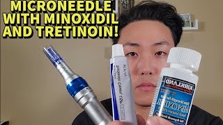 HOW TO MICRONEEDLE WITH MINOXIDIL AND TRETINOIN FOR MAXIMUM HAIR GROWTH STEP BY STEP GUIDE [upl. by Turnheim]