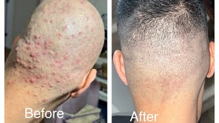 folliculitis treatment Scalp acne treatment  my problem SOLVED ￼ pls read description [upl. by Lamont535]