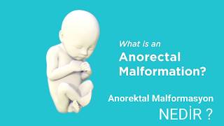 Anorektal Malformasyon Nedir [upl. by Reema811]