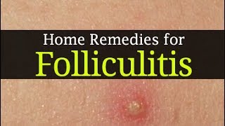 10 Home Remedies for Folliculitis and Best Home Treatment methods [upl. by Stasny726]