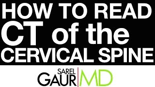 How to Read CT of the Cervical Spine [upl. by Eartnoed279]