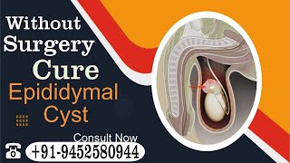 How do you get rid of an epididymal cyst naturally Know by Dr Nizamuddin Qasmi sir [upl. by Greyso]