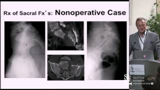 Management of Sacral Fractures by Jens Chapman MD [upl. by Vivie929]